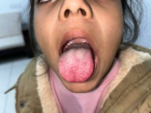 One of the symptoms of Scarlet fever
