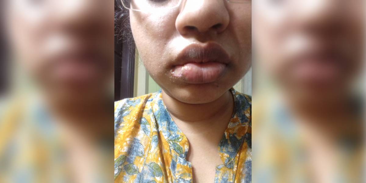 A portion of the woman's lip was alleged burnt off during a dental procedure. (X/sowmya_sangam)