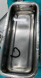 Live leech that the 40-year-old woman had swallowed and was stuck in her throat.