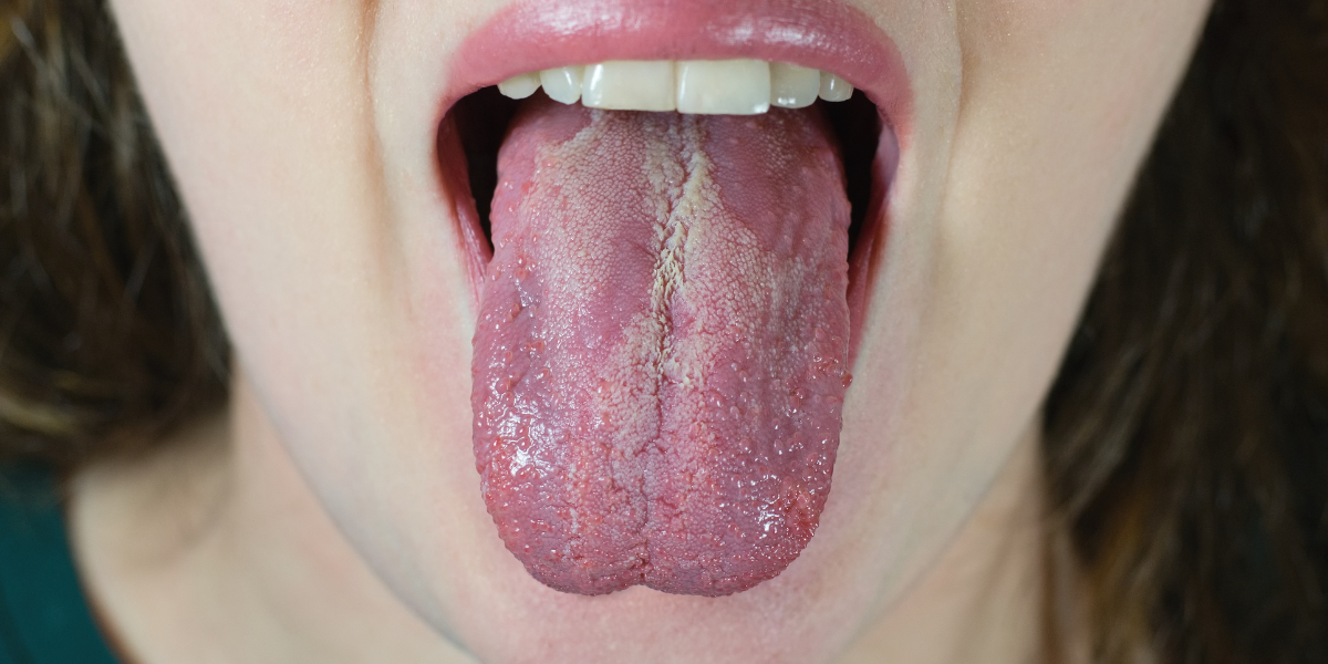 Oral cancer. Representational image. (Creative Commons)