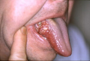 Lumps and bumps on the tongue. (Creative Commons)
