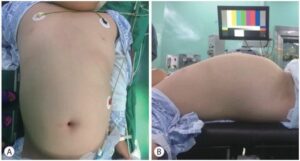 The abdomen of the 13-year-old boy was severely distended. (A) Front view. (B) Side view.